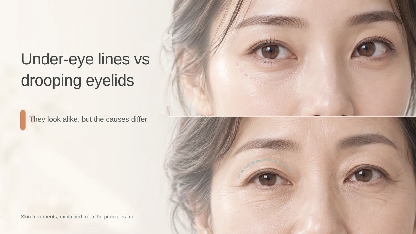 Under-Eye Wrinkles and Drooping Eyelids Are Not the Same Problem